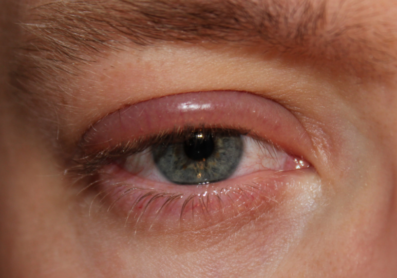 An eye with blepharitis