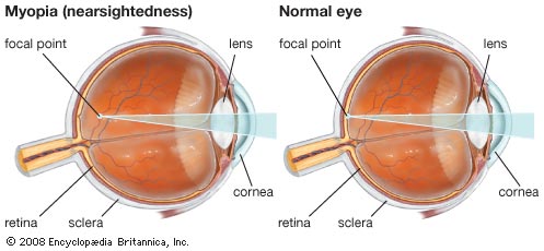 myopia chart